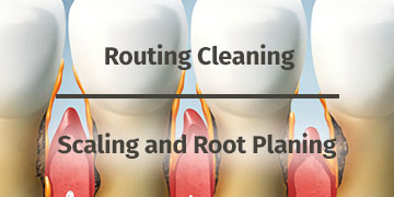 scaling and root planing in melbourne