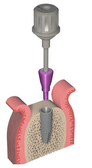 dental implant screw graph