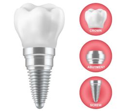 dental implant Melbourne